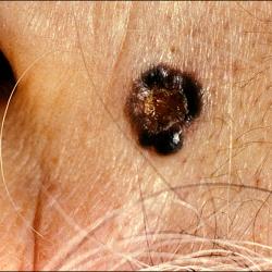 Example of skinCancer